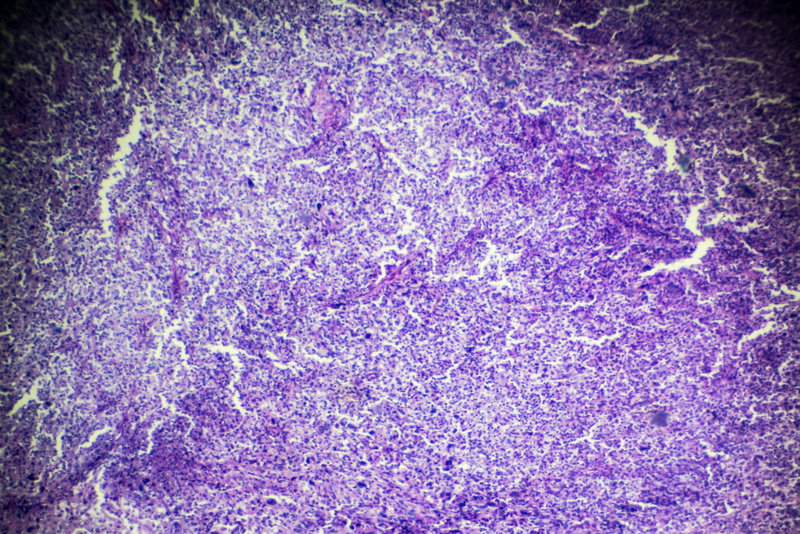 Rhabdomyosarcoma biopsy under microscopy zoom in different range